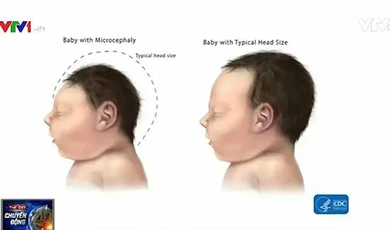 Florida (Mỹ) xác nhận sản phụ đầu tiên nhiễm Zika sinh con đầu nhỏ