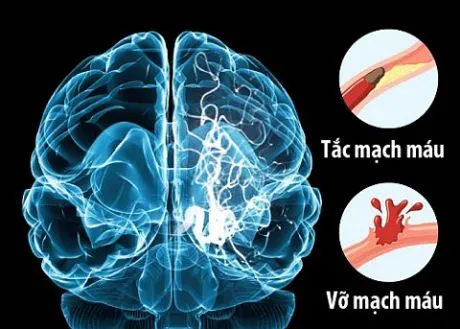 Tìm hiểu về căn bệnh đột quỵ gây nguy hiểm tính mạng