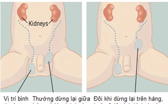 Phát hiện sớm tinh hoàn ẩn ở trẻ