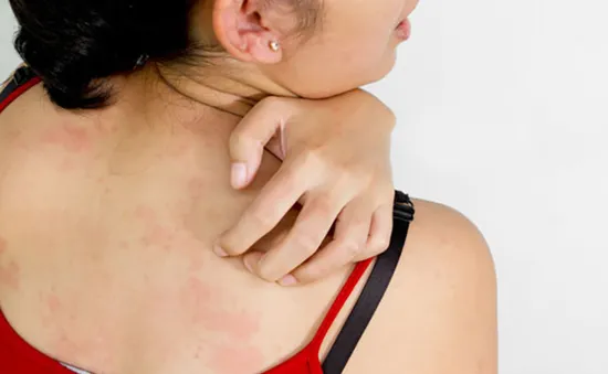 Nếu có một trong những triệu chứng này, bạn cần đi khám lupus ngay