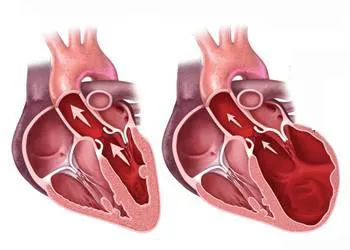 Bệnh lý cơ giãn tim có tỷ lệ tử vong cao