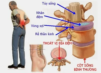 Điều trị thoát vị đĩa đệm hiệu quả bằng Đông y