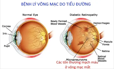 Tìm hiểu bệnh võng mạc do đái tháo đường