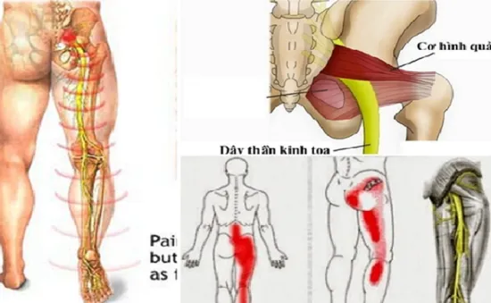 Các biện pháp chữa đau lưng, đau thần kinh tọa do thoát vị đĩa đệm