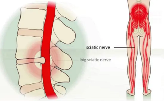 Phát hiện sớm và điều trị bệnh đau lưng, đau thần kinh tọa