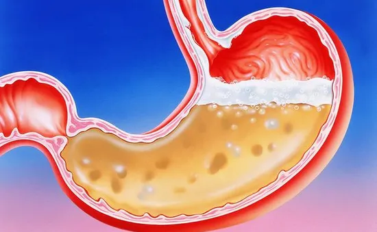 Một số dấu hiệu "tố" bạn có vấn đề về dạ dày