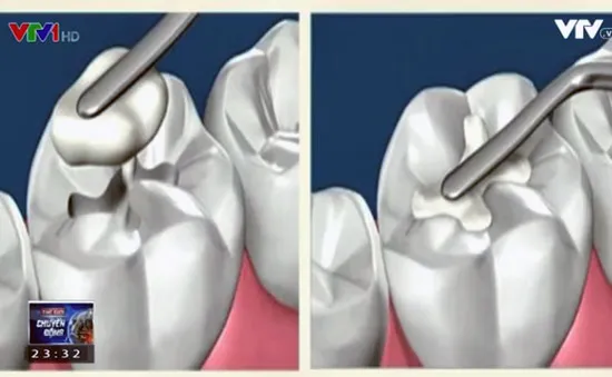 Công nghệ tái tạo răng - Bước nhảy vọt trong lĩnh vực nha khoa