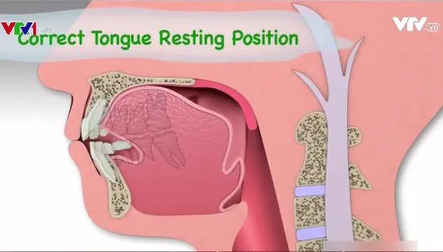 Nguyên nhân răng mọc xô lệch