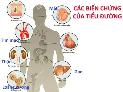 Việt Nam thuộc top các nước có tỷ lệ gia tăng bệnh tiểu đường cao nhất thế giới