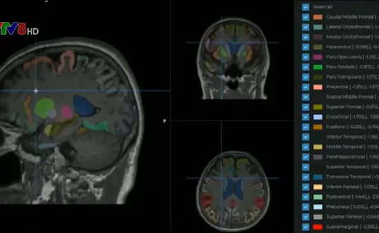 Hàn Quốc phát triển công nghệ chẩn đoán Alzheimer