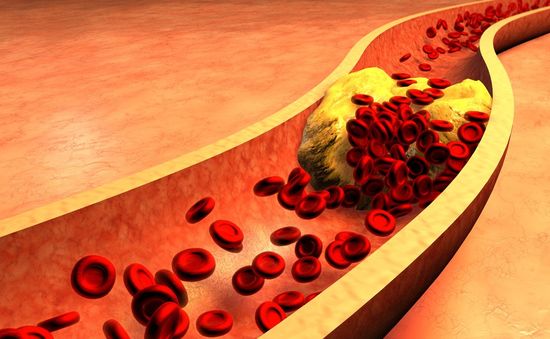 Cholesterol xấu có thể không phải là thủ phạm gây bệnh tim mạch