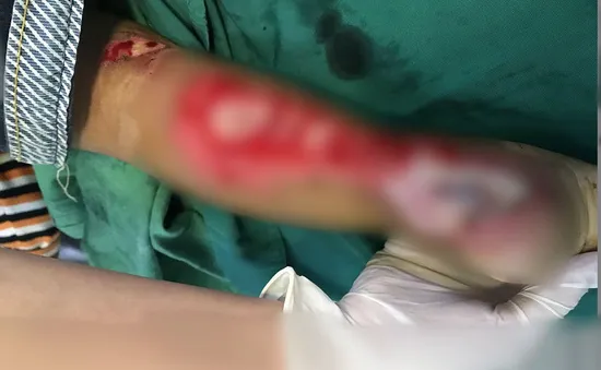 Bé gái 2 tuổi bị nan xe máy bào thịt, cắt đứt gân chân