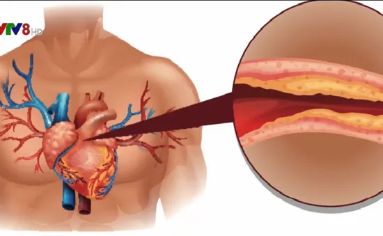 Phát hiện mới: Lượng cholesterol tốt quá cao dễ gây đau tim