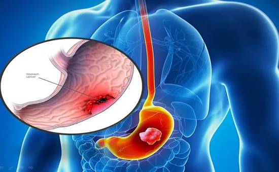 Tìm hiểu về khối u dạ dày lành tính, ác tính