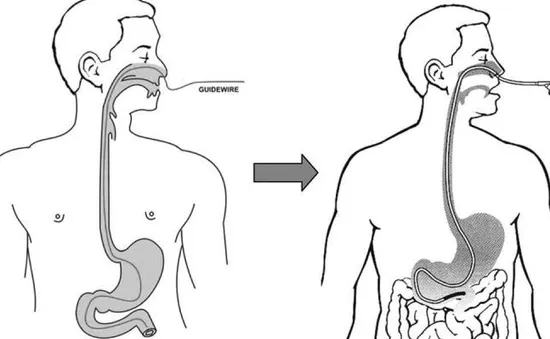 Lạng Sơn: Triển khai nội soi dạ dày qua đường mũi