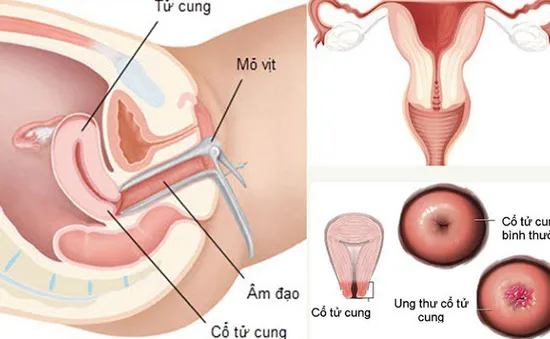 Hầu hết phụ nữ bỏ qua 3 dấu hiệu của ung thư cổ tử cung