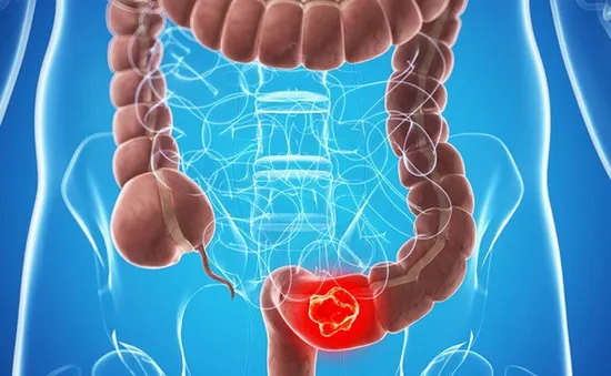 Các dấu hiệu sớm ung thư đại trực tràng?