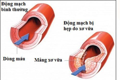 Hồng sâm lên men enzyme - chống xơ vữa động mạch