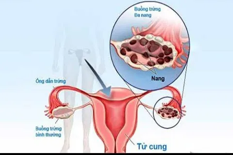 Điều trị hội chứng u đa nang buồng trứng