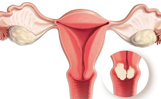 Thủ phạm gây ung thư cổ tử cung, bạn có biết để phòng tránh?