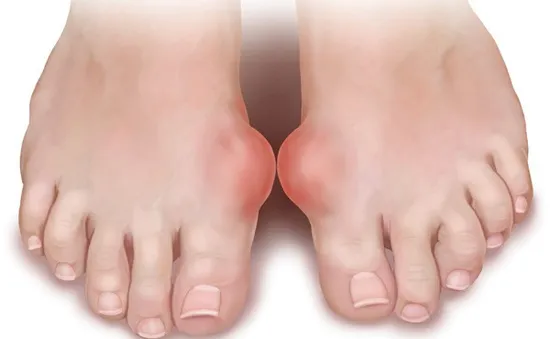 Chế độ ăn dự phòng và điều trị người bị bệnh gout