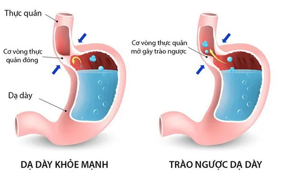 8 dấu hiệu cảnh báo bệnh viêm thực quản trào ngược