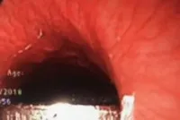 Bé gái bị đồng xu mắc kẹt ở thực quản