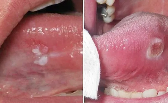 Tưởng bị nhiệt miệng, đi khám phát hiện ung thư lưỡi