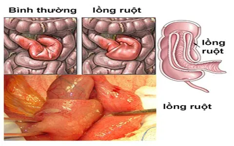 Bệnh lồng ruột cấp ở trẻ em: Cần can thiệp sớm trong vòng 24 giờ