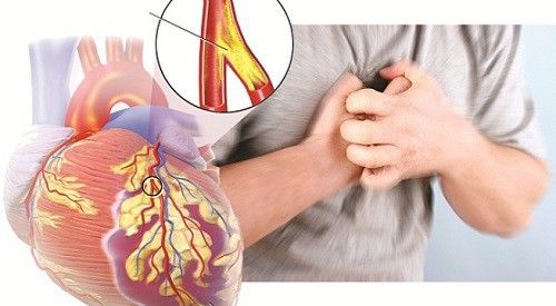 Phát hiện và điều trị bệnh động mạch vành