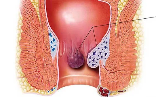 Điều trị trĩ không đúng cách, bệnh nhân phải truyền 13 đơn vị máu