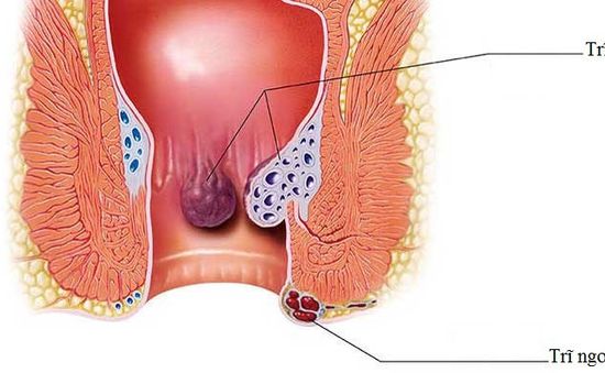 Bệnh trĩ không xấu - Tại sao phải giấu?