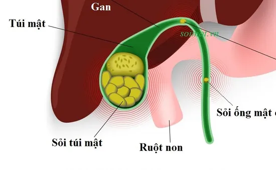 10 - 25% dân số mắc bệnh lý sỏi đường mật