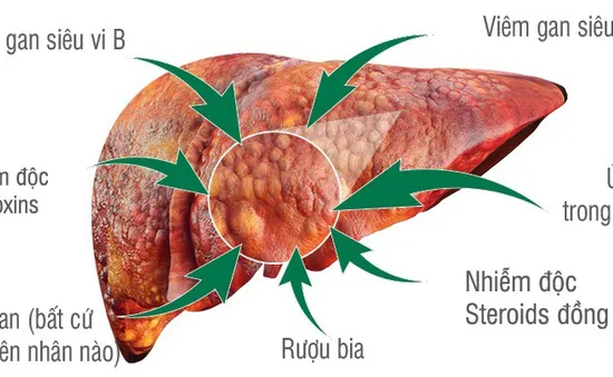 Nguyên nhân gây ung thư gan ít người biết