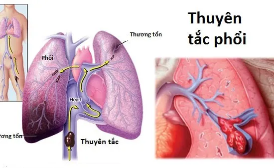 Thuyên tắc phổi - Bệnh do nằm bất động quá lâu có thể gây tử vong