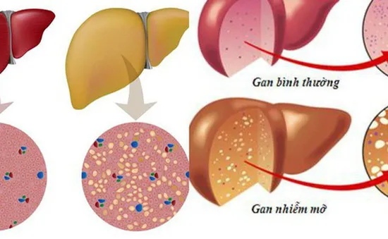 Top 4 nguyên nhân gây gan nhiễm mỡ và cách phòng tránh