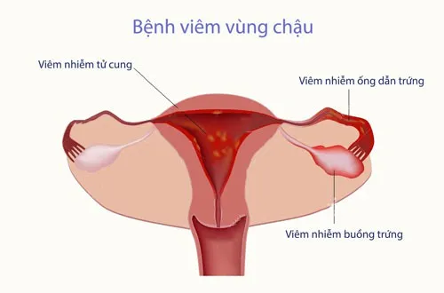 Bùng nổ căn bệnh lây lan qua đường tình dục khiến phụ nữ vô sinh