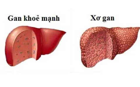 Những điều đáng lưu ý về bệnh xơ gan