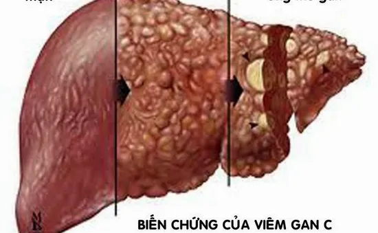 Những hiểu lầm tai hại về bệnh viêm gan virus