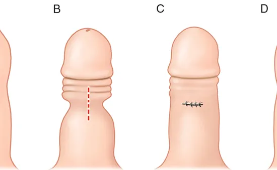 Bệnh về bao quy đầu - Đừng chủ quan