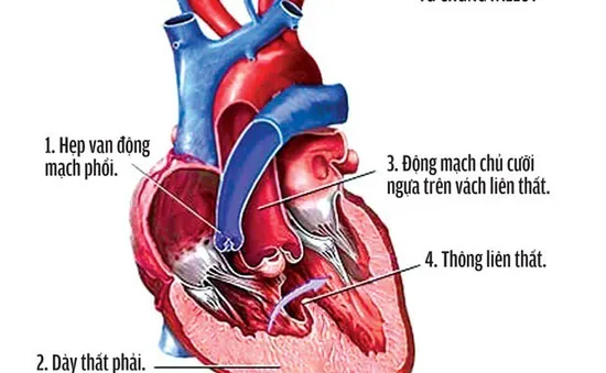 Những điều cần biết về bệnh tim bẩm sinh Tứ chứng Fallot