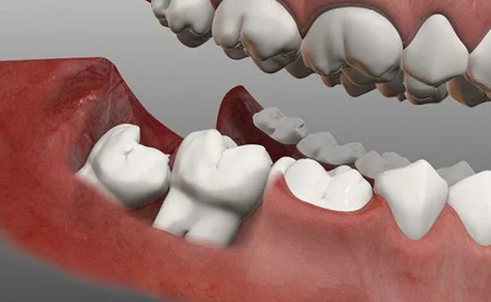 Đau răng khôn: Những điều quan trọng bạn cần biết