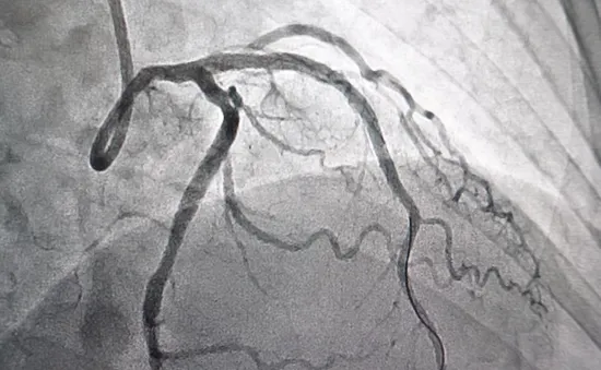 Những lưu ý sau khi đặt stent động mạch vành