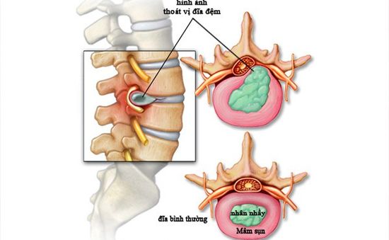 Những biến chứng nguy hiểm của thoát vị đĩa đệm