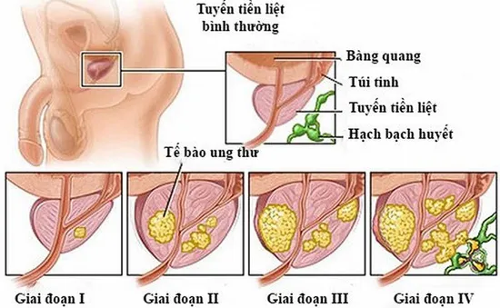 Điều trị ung thư tuyến tiền liệt di căn