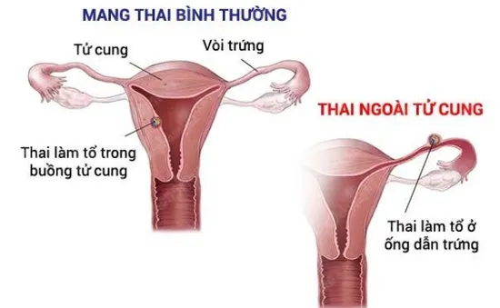 Dấu hiệu nào cho thấy bạn đang mang thai ngoài tử cung?