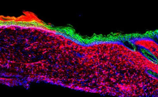 Đột phá công nghệ tế bào giúp chữa lành vết loét da lớn