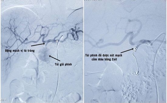 Nút mạch điều trị giả phình động mạch tá tràng cho bệnh nhân