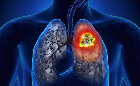 Ung thư phổi: Căn bệnh phổ biến