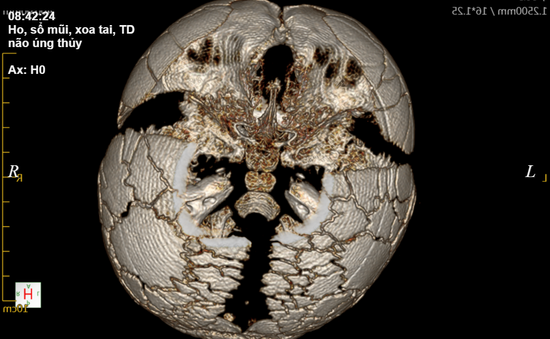 Bé trai 1 tuổi mắc bệnh loạn sản xương đòn, sọ cực hiếm gặp